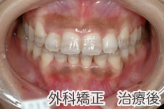 外科矯正治療後