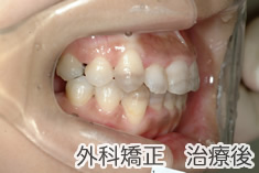 外科矯正治療後
