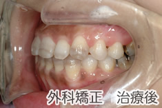 外科矯正治療後
