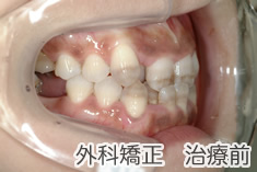 外科矯正治療前