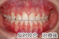 反対咬合治療後