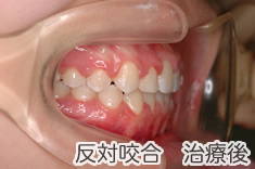 反対咬合治療後