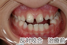 反対咬合治療前