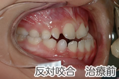 反対咬合治療前