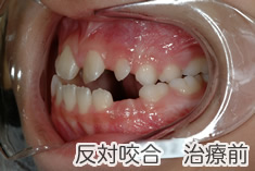 反対咬合治療前