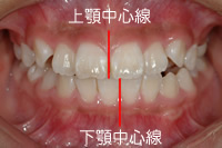 正中線のずれ