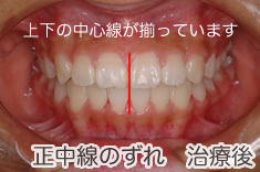 正中線のズレ治療後