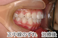 正中線のズレ治療後