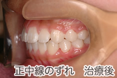正中線のズレ治療後