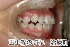 正中線のズレ治療前
