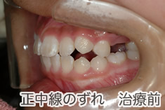 正中線のズレ治療前
