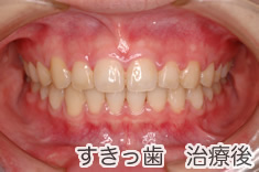 すきっ歯治療後