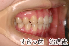 すきっ歯治療後