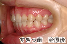 すきっ歯治療後