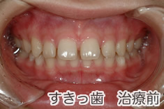 すきっ歯治療前