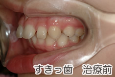 すきっ歯治療前